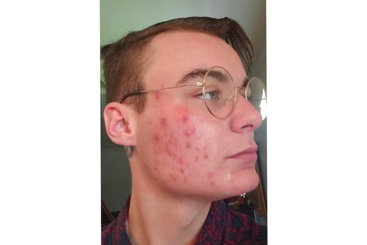 person with acne going through hormone therapy.